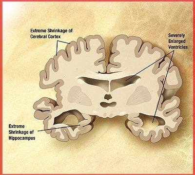 болезнь Альцгеймера  - мозг больного человека