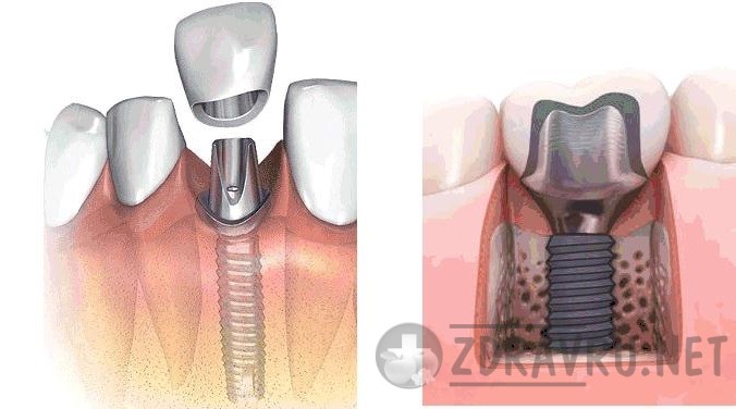 Временный имплант. Временная коронка на имплант. Винтовое крепление коронки к импланту. Временная коронка на имплантате. Временные пластмассовые коронки на имплантатах.