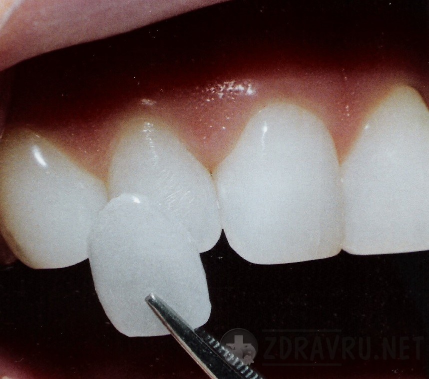 Какие бывают фиксированные зубные протезы - виниры 