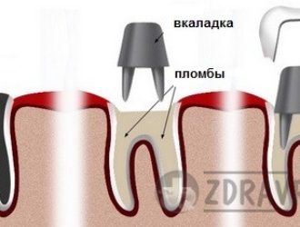 Фиксированные зубные протезы — какие бывают?