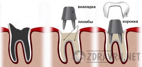 Какие бывают фиксированные зубные протезы - вкладки 