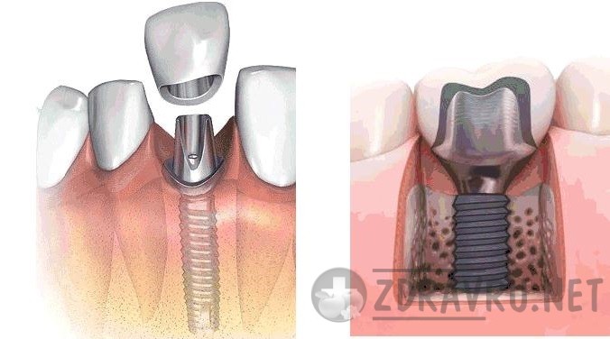 Какие бывают фиксированные зубные протезы - имплатнтанты