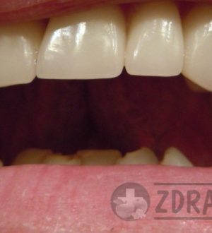 Зубной камень у человека: причины и последствия