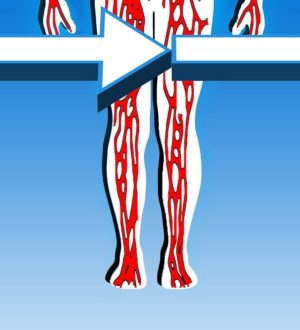 Тромбофлебит: симптомы, причины, лечение